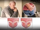 प्रोस्टेट कैंसर (Prostate cancer)