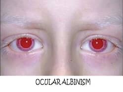 International Albinism Awareness Day: Symptoms Of Ocular Albinism And Tips To Cope With It