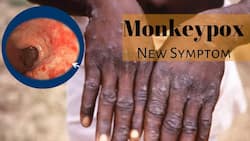 New Symptoms of Monkeypox: Painful Inflammation In Rectum Can Be A Warning Sign, CDC Issues Advisory
