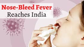 Rare Nose-Bleed Fever Enters India: 55-Year-Old Gujarat Woman Dies of Complications, 1 More Tests Positive