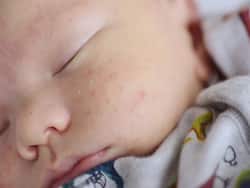 Baby Acne: Causes, Treatment