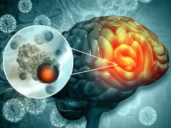 Having Constant Headaches? Beware of These 7 Silent Symptoms of Brain Cancer