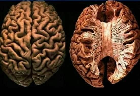 7 Warning Symptoms Your Brain Is Eating Itself | TheHealthSite.com