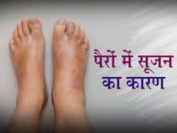 Swollen Feet: पैरों में सूजन शरीर की इन 5 गड़बड़ियों का है संकेत, जानें एक्सपर्ट की राय