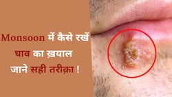 Remedies for Monsoon Wound: मानसून में होने वाले घावों का कैसे रखें ख्याल, इन उपायों से होगा इलाज, Watch Video
