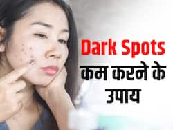 चेहरे पर डार्क स्पॉट्स से हैं परेशान तो इस तरह की डाइट लेना करें स्टार्ट, स्किन बनेगी हेल्दी और स्पॉटलेस