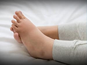 Diabetes Swollen Feet Treatment at Home
