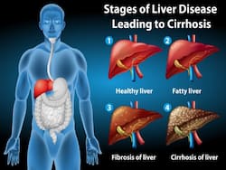 Foods To Avoid If You Have Fatty Liver