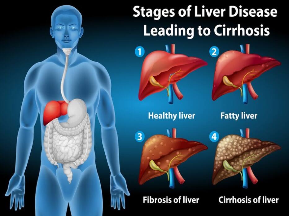 Let Us Understand The Role Of Hepatitis A And B In Liver Disease