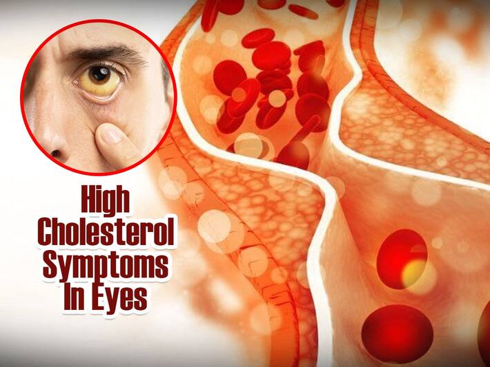 5 High Cholesterol Symptoms In Eyes You Should Know