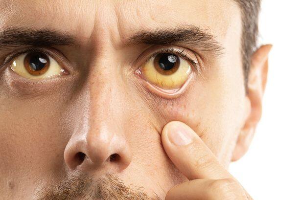 'Silent' high cholesterol symptom you can spot in your EYES - and millions  could have it - Mirror Online