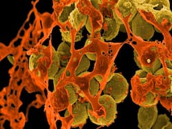 New MRSA Strain Alarms Experts: Be Aware Of The Symptoms And Take Precautions