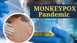 Monkeypox Declared Pandemic By World Health Network, Warns of Rapid Transmission