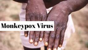 Monkeypox Mutating Faster Than Though: 7 Warning Symptoms You Should Never Ignore