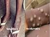 Monkeypox And Smallpox: How Are They Different From Each Other?