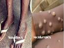 Monkeypox And Smallpox: How Are They Different From Each Other?