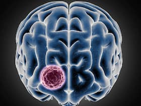 6 Recommended Vitamins And Supplements That Can Prevent Brain Tumours