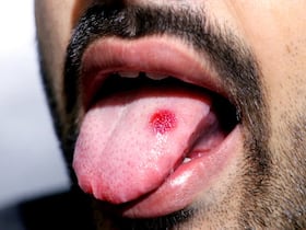 Oral Cancer Cases Rising At An Alarming Rate In India: Doctors Reveal The Primary Cause