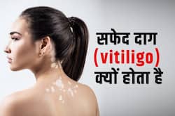 Vitiligo day 2022: सफेद दाग की शुरुआत कैसे होती है? एक्सपर्ट से जानें कारण और लक्षण