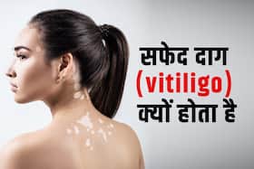 Vitiligo day 2022: सफेद दाग की शुरुआत कैसे होती है? एक्सपर्ट से जानें कारण और लक्षण