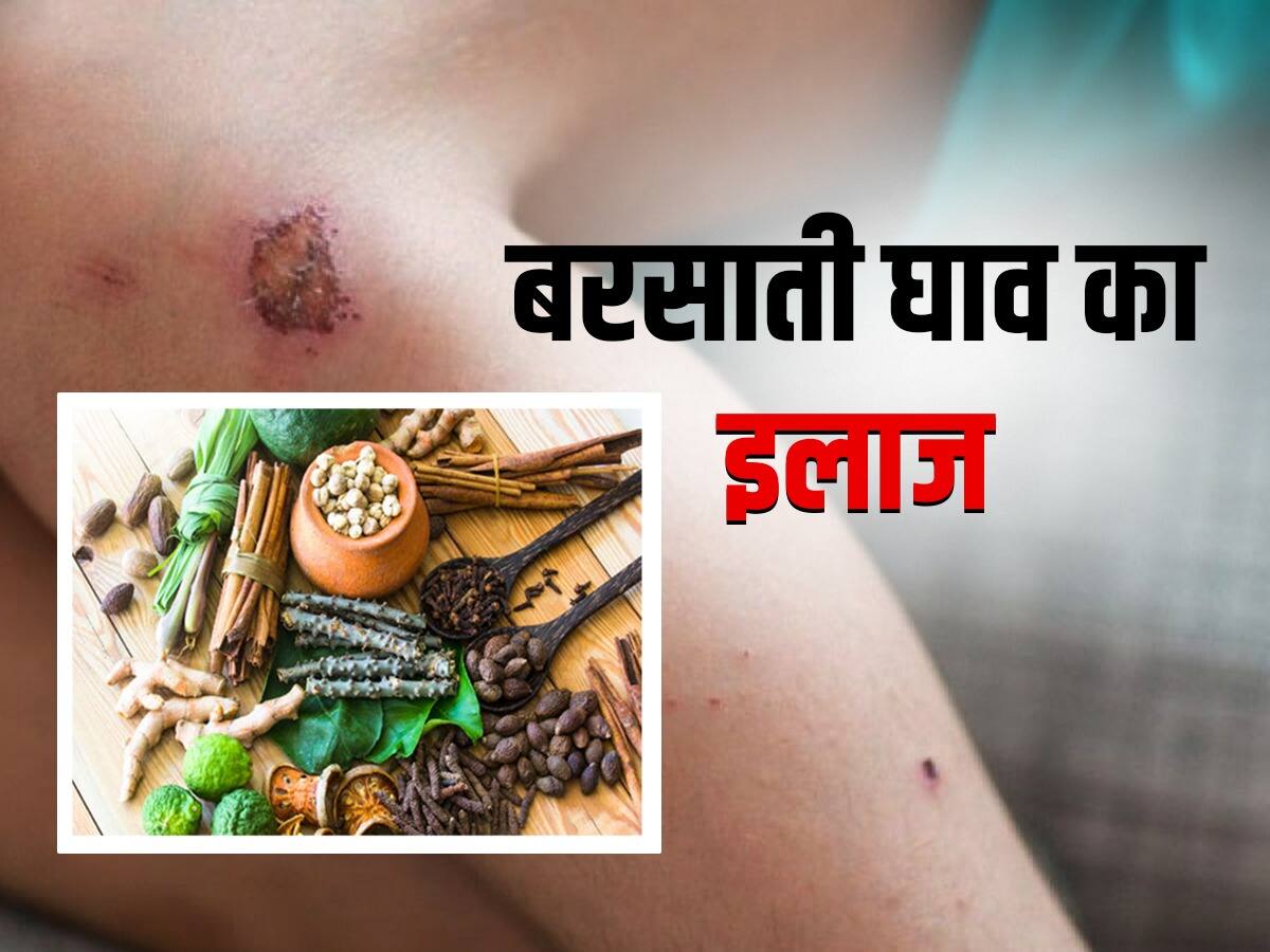 बरसाती घाव का घरेलू उपचार: इस्तेमाल करें ये 5 जड़ी बूटियां | Barsati ...