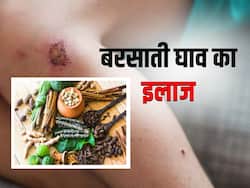 बरसाती घाव में घरेलू उपचार के लिए इस्तेमाल करें ये 5 जड़ी बूटियां, जानें तरीका और फायदे