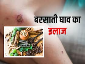 बरसाती घाव में घरेलू उपचार के लिए इस्तेमाल करें ये 5 जड़ी बूटियां, जानें तरीका और फायदे