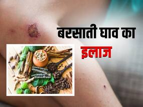 बरसाती घाव में घरेलू उपचार के लिए इस्तेमाल करें ये 5 जड़ी बूटियां, जानें तरीका और फायदे