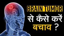 Brain Tumor Day: क्या होता है ब्रेन ट्यूमर, जाने इसके लक्षण और इसका इलाज डॉक्टर से, Watch Video