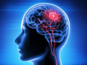 20 साल से कम उम्र के लोगों को भी हो सकता है ब्रेन ट्यूमर, जानिए कारण, लक्षण और उपचार
