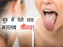 मुंह में लाल और सफेद झाग दिखाई देना है इस कैंसर का संकेत! 75 हजार लोग गंवाते हैं अपनी जान
