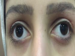 International Nystagmus Awareness Day: All About This    Dancing Eye    Disease