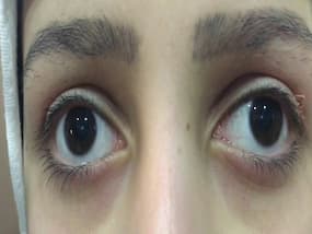 International Nystagmus Awareness Day: All About This    Dancing Eye    Disease