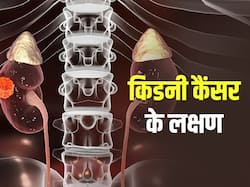 किडनी कैंसर का खतरा बढ़ाती हैं ये 5 चीजें! एक्सपर्ट से जानें किडनी कैंसर के शरीर पर दिखाई देने वाले लक्षण