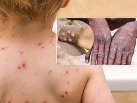 5 Ways To Distinguish Monkeypox From Chickenpox