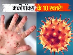 मंकीपॉक्स के मामलों की संख्या 1000 के पार, डब्लूएचओ के इन 10 प्वाइंट्स से जानें असली खतरा हुआ अब शुरू