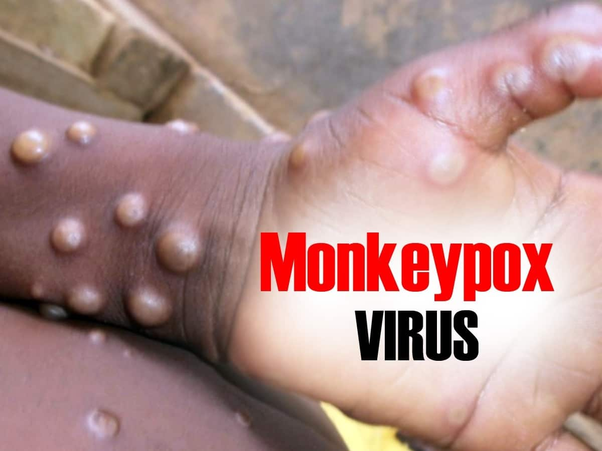 Monkeypox: How It Affects the Eyes and What You Can Do