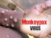 Will Monkeypox Spread Like Covid? Know What Doctors Say