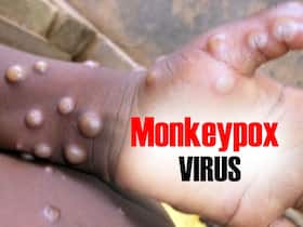 Monkeypox Suspected In 5-Year-Old Ghaziabad Girl