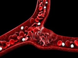 World Sickle Cell Day 2022: Understanding This Blood Disorder And Its Complications