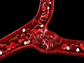 World Sickle Cell Day 2022: Understanding This Blood Disorder And Its Complications World Sickle Cell Day 2022: Understanding This Blood Disorder And Its Complications