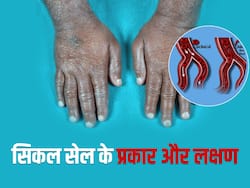 शरीर में दर्द और बार-बार बैक्टीरियल इंफेक्शन होना सिकल सेल बीमारी के हैं लक्षण, जानें इसके 4 प्रकार