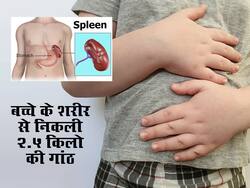 अजीब बीमारी: 13 वर्षीय लड़केके शरीरसे निकली 2.5 किलो की गांठ, डॉक्टरों ने रोबोटिक सर्जरी से दिया अंजाम