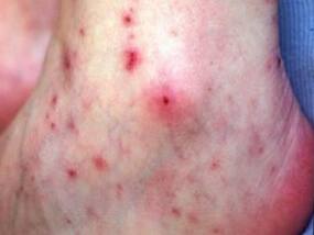Meningococcal Disease