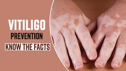 World Vitiligo Day 2022: Treatment and Prevention Of This Skin Disease