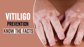 World Vitiligo Day 2022: Treatment and Prevention Of This Skin Disease World Vitiligo Day 2022: Treatment and Prevention Of This Skin Disease