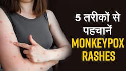 Monkeypox Rashes : बॉडी पर रैशेज Monkeypox के हैं या फिर Chickenpox का हैं संकेत, इन 5 तरह से पहचानेंः watch Video