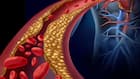 Atherosclerosis