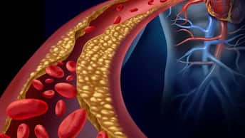 Atherosclerosis