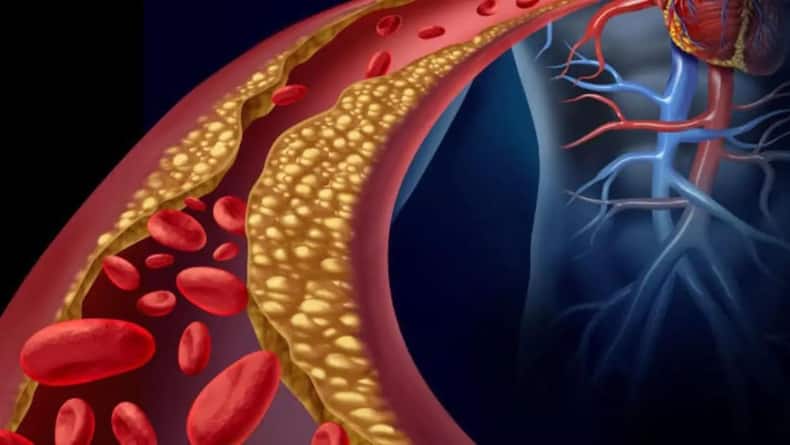 atherosclerosis